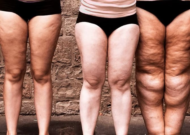 Três pares de pernas lado a lado ilustrando diferentes graus de lipedema